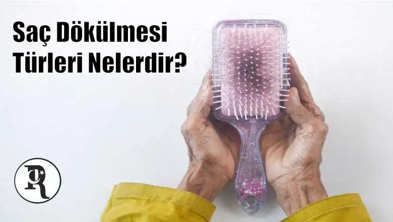 Saç Dökülmesi Türleri Nelerdir?
