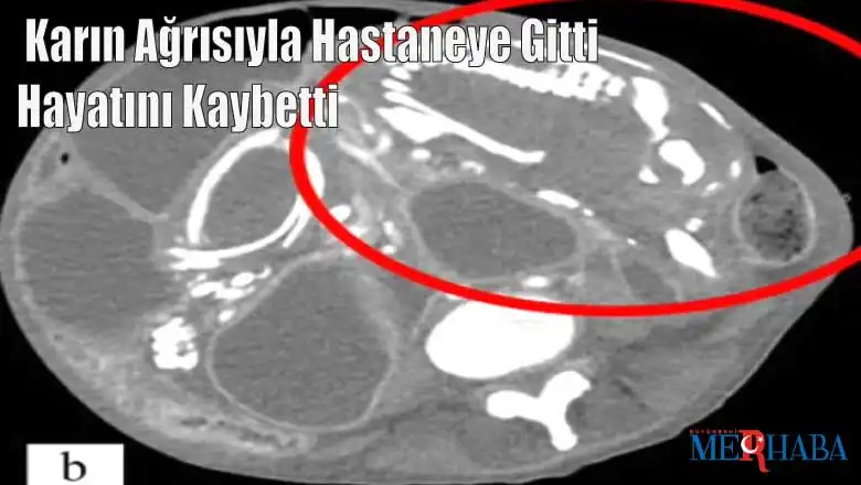 Karın Ağrısıyla Hastaneye Gitti Hayatını Kaybetti